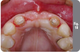 Restaurarea defectului, format după îndepărtarea dintelui în zona semnificativă din punct de vedere estetic -