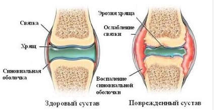 Chondroprotectors generation ízületek, lista, szabályzat hondroprotektorami kezelés