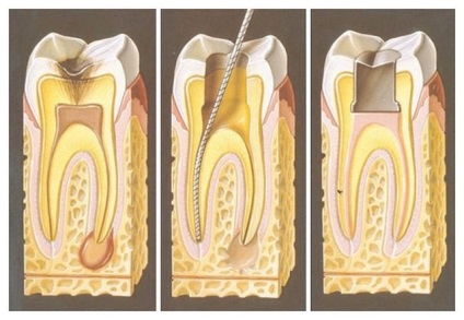 Pulpită cronică specie, cauze, simptome, diagnostic, tratament și posibil