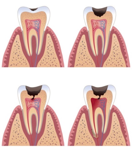 Pulpită cronică specie, cauze, simptome, diagnostic, tratament și posibil