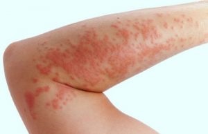 Este urticaria și modul în care este transmisă de la persoană la persoană