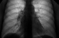 Adenocarcinomul pulmonar - cauze, simptome, diagnostic și tratament