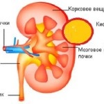 Adenomul renal - tratamentul este posibil