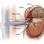 Adenomul renal - tratamentul este posibil