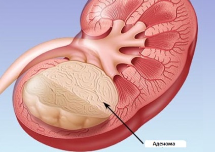 Adenomul renal - tratamentul este posibil