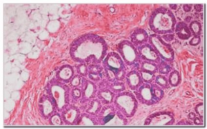 Adenoză a glandelor mamare - tratament, prognostic, forme, diagnostice