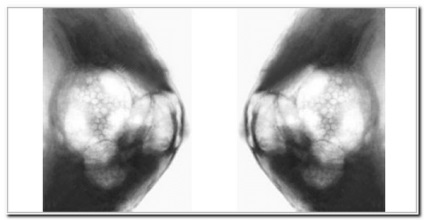 Adenosis emlő-mirigy - kezelés, prognózis, formák, diagnosztika