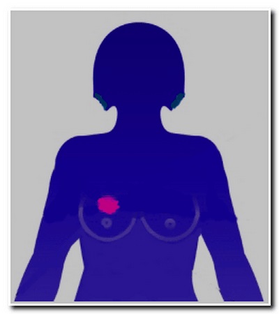 Adenosis emlő-mirigy - kezelés, prognózis, formák, diagnosztika