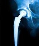 Aspecte tematice ale artrozei ortopedice, traumatologie pentru toți