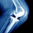 Aspecte tematice ale artrozei ortopedice, traumatologie pentru toți