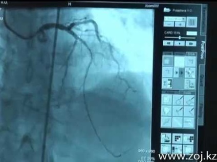 Angioplastie și stenirovanie vaselor coronariene ce este