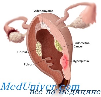 Sângerări uterine anormale (amk)