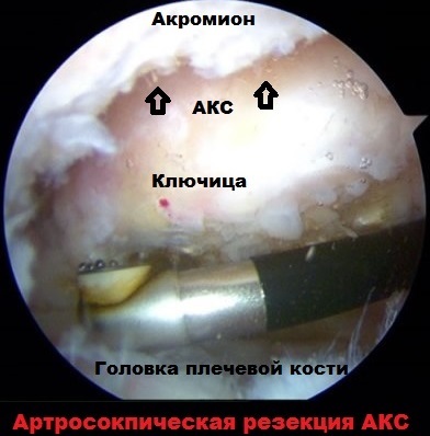 Artroza articulației umărului și a articulației acromioclaviculare (ax)