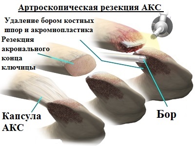 Artroza articulației umărului și a articulației acromioclaviculare (ax)