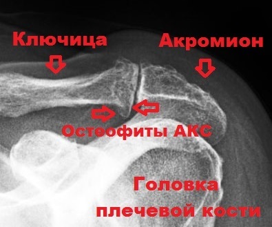 Osteoarthritis a váll ízület és acromioclavicular közös acromioclavicular (ax)