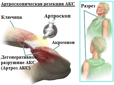 Artroza articulației umărului și a articulației acromioclaviculare (ax)