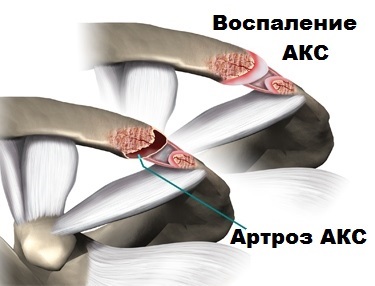 Artroza articulației umărului și a articulației acromioclaviculare (ax)