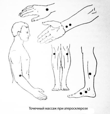 lábak Arteriosclerosis okok és a kezelés