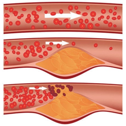 lábak Arteriosclerosis okok és a kezelés