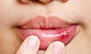Rănitele albe din gură în tratamentul copiilor răniți