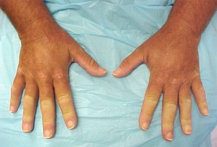 Boala lui Raynaud