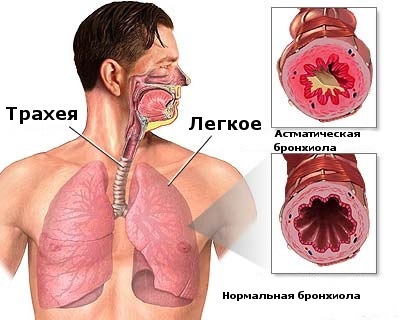 Tratamentul bronșic al astmului, diagnosticul, tipurile, semnele astmului