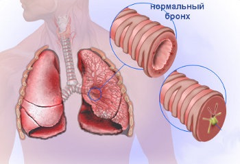 Bronșita, semne, tratament, exerciții cu bronșită - site-ul 