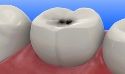 Puncte negre pe dinți datorită sigiliului cum să evite apariția lor