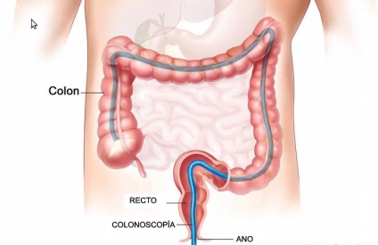Що таке колоноскопія