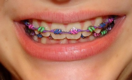 színes fogszabályozó