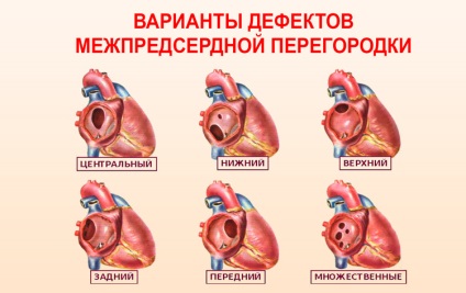 Septal defectului secundar defecte secundare cardiace congenitale la nou-născuți și adulți