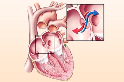 Septal defectului secundar defecte secundare cardiace congenitale la nou-născuți și adulți