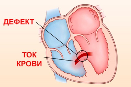 Septal defectului secundar defecte secundare cardiace congenitale la nou-născuți și adulți