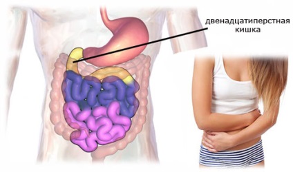Duodenita - care sunt simptomele și tratamentul, drogurile, prognosticul