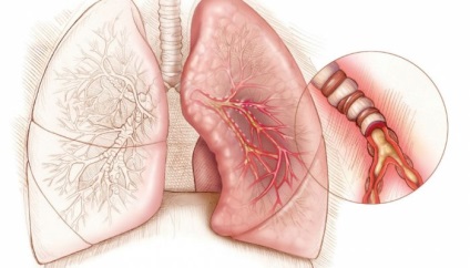 Forme de clasificare a astmului bronșic