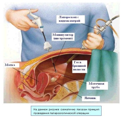 Gaze după laparoscopie cum să curăță, exerciții și alte metode