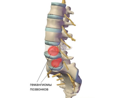 Hemangiomul coloanei vertebrale