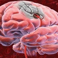 Hipoxia creierului - cauze, simptome, tratament