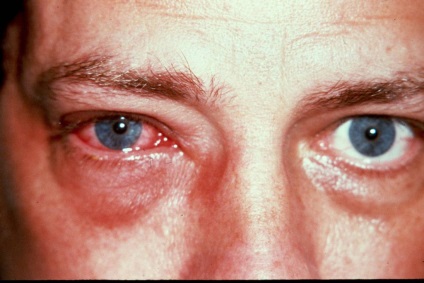 Simptome de gripă oculară, complicații la nivelul ochilor după gripă și tratament