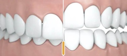 Overbite diagnózis és a kezelés, megelőzés hatékonysága