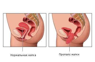 Hernia simptomelor, semnelor, diagnosticului și tratamentului uterului