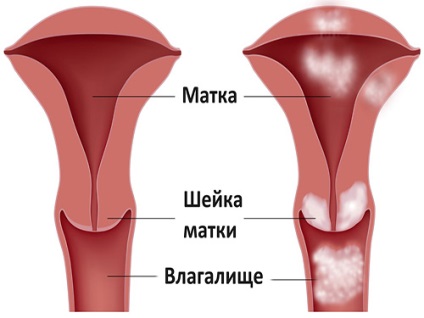 Femeia are o perioadă cu cancer