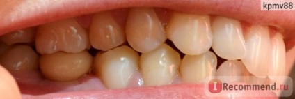 Implantarea dintelui - implantare dentară în clasa economică a clinicii