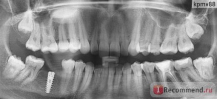 Implantarea dintelui - implantare dentară în clasa economică a clinicii
