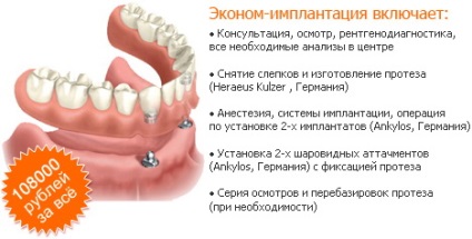 Implantarea dinților ieftină - economie-implantare complexă la Moscova