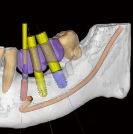 Implantul de dinți la cheie la Moscova, în Kuntsevo (la vest de Moscova), în clinica dentară