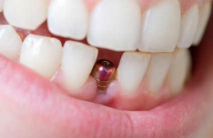 Implantarea dinților la Moscova, prețuri și tipuri, costul instalării implanturilor dentare la cheie, artox