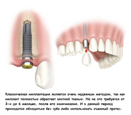 Implantarea dinților la Moscova, prețuri și tipuri, costul instalării implanturilor dentare la cheie, artox