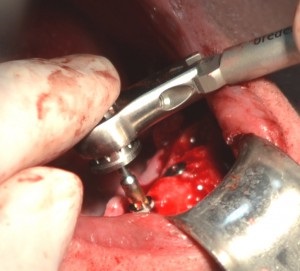 Implantologie, aladent