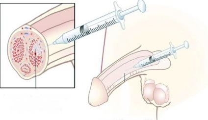 Intracavernoasă injecție în penis pentru a alege